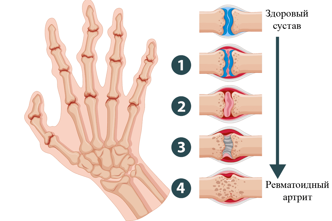Воспаление запястного сустава. Сустав. Ревматоидный артрит психосоматика. Фунготерапия артрит.